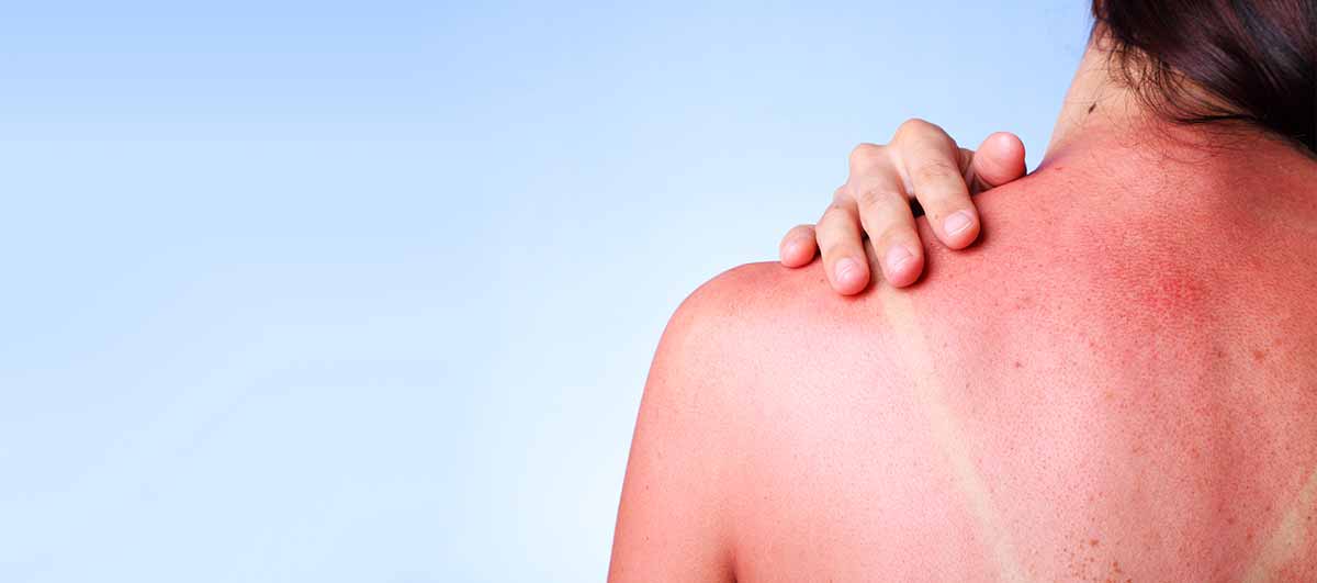 Apple Cider Vinegar for Sunburn: Can it Really Help in Curing the