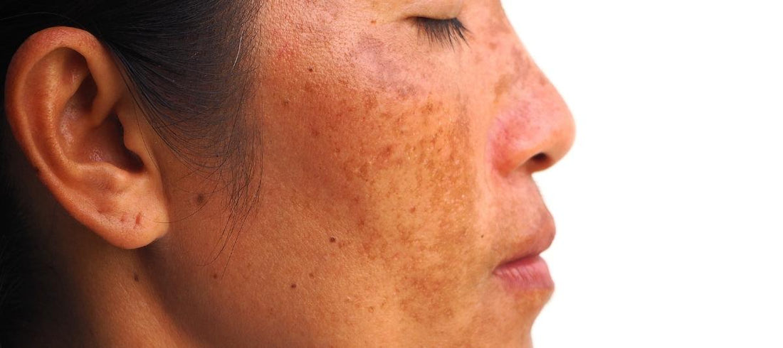 Know How Skipping This One Step Can Worsen Melasma