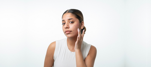 Understanding the difference between Hormonal and Bacterial Acne